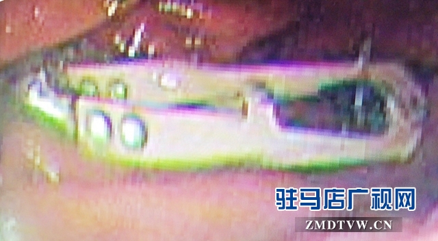 這一幕看呆醫(yī)生！男子胃里竟然有把剪刀！