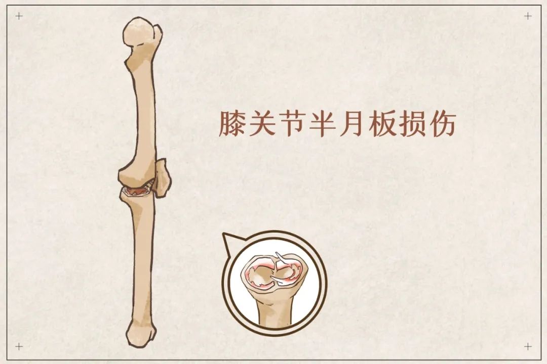 盲目鍛煉？你的半月板傷不起