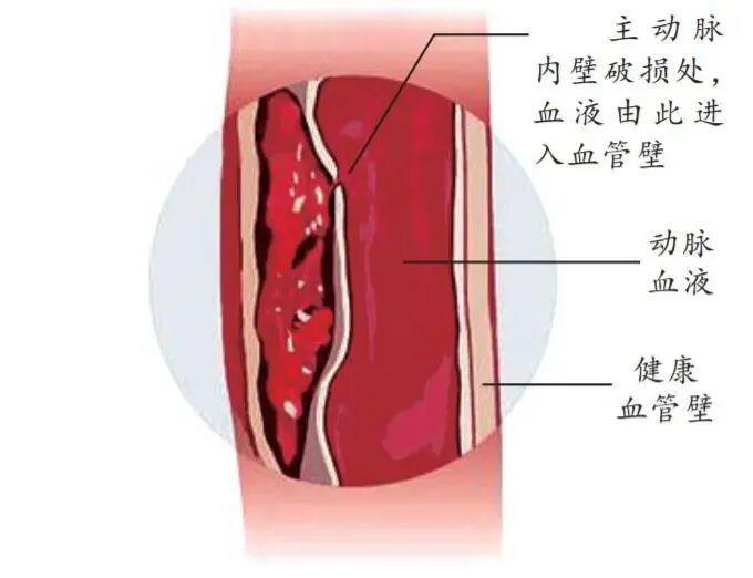 防寒更要防??！醫(yī)生提醒：別讓低溫“凍”破主動(dòng)脈